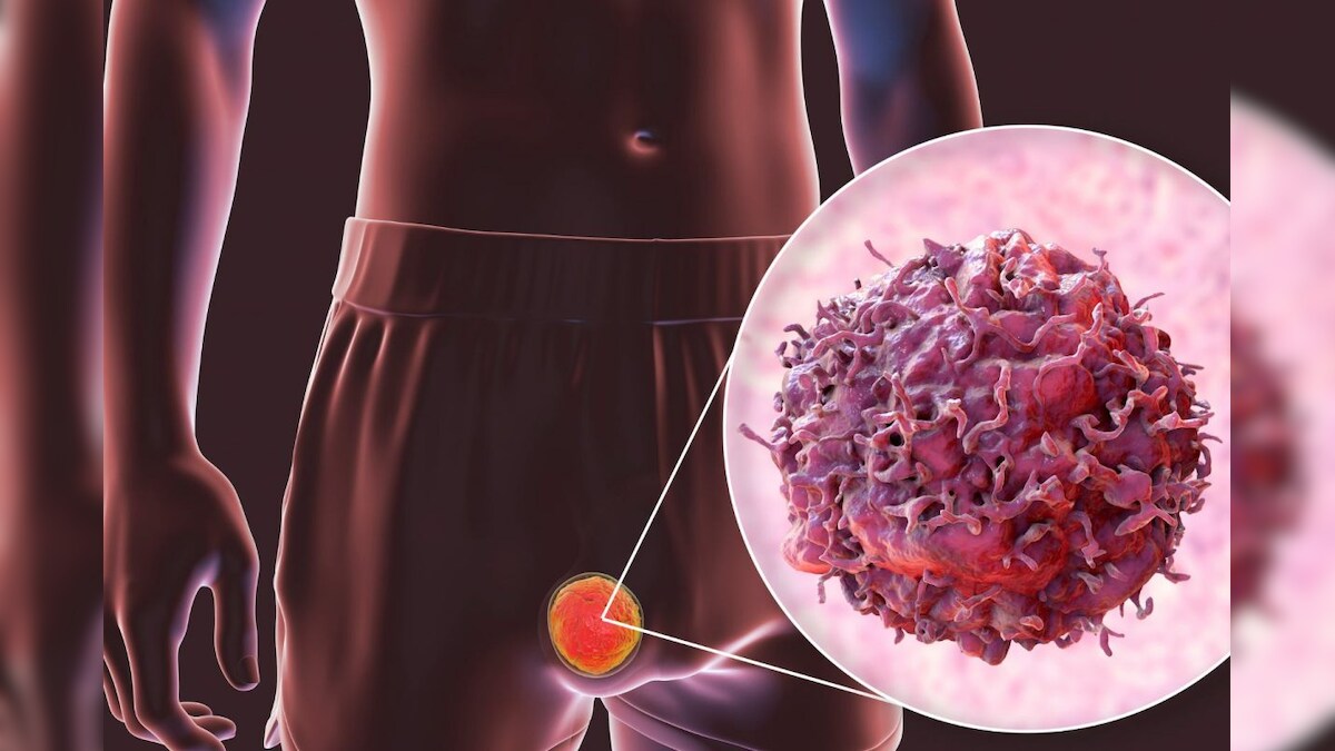 ஆண்களை தாக்கும் விதைப்பை புற்றுநோய்.. ஆரம்பநிலை அறிகுறிகள் எப்படி இருக்கும்..? – News18 தமிழ்