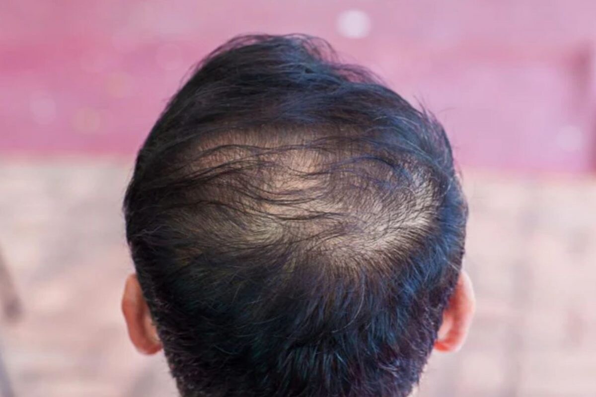 வழுக்கை தலையில் மீண்டும் முடி வளர ஆராய்ச்சியாளர்கள் புதிய கண்டுபிடிப்பு..! - News18 தமிழ்