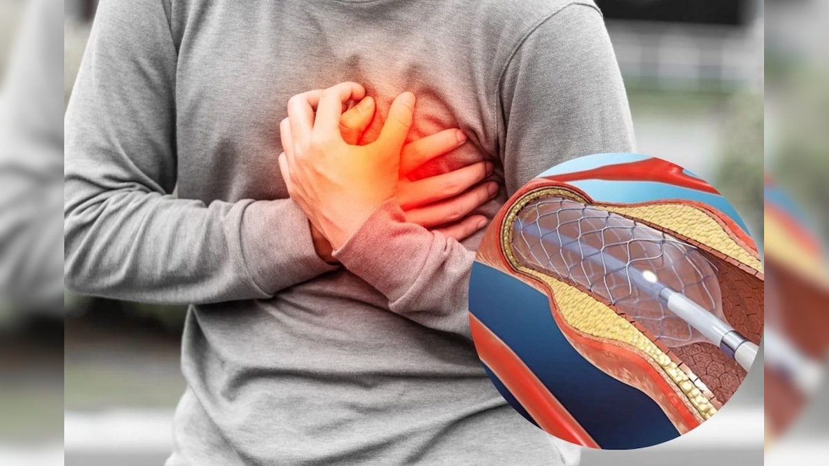 ஸ்டென்ட் வைத்த பின் மீண்டும் மாரடைப்பு வராமல் இருக்க முன்னெச்சரிக்கை நடவடிக்கைகள்..!