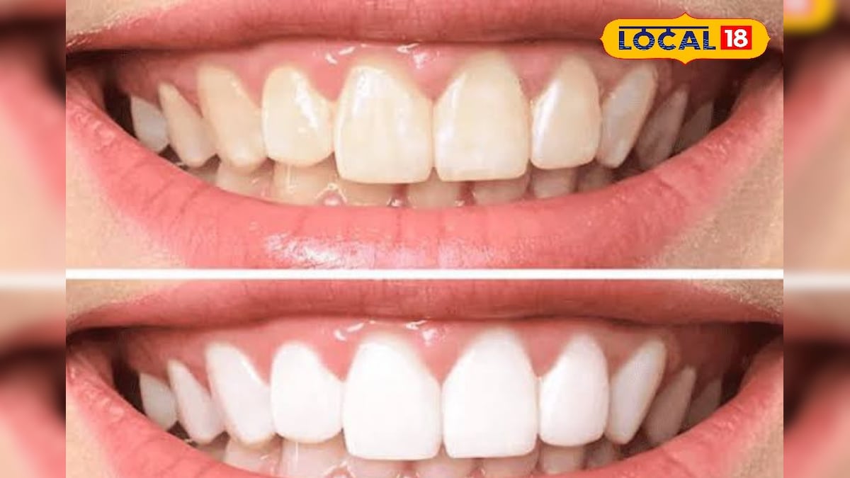 Tips for White Teeth: பளிச்... பளிச்... பற்கள் வெண்மையாக 10 நிமிஷம் போதும்... வீட்டில் உள்ள இந்த பொருட்களை யூஸ் பண்ணி பாருங்க...