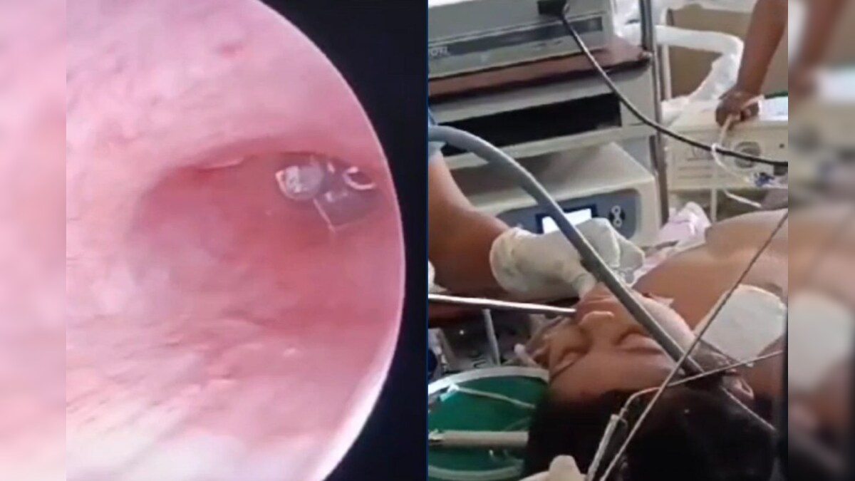 எல்இடி பல்பை விழுங்கிய 3 வயது சிறுவன்... பதறிய பெற்றோர்.. பரபரப்பான நெல்லை அரசு மருத்துவமனை - News18 தமிழ்