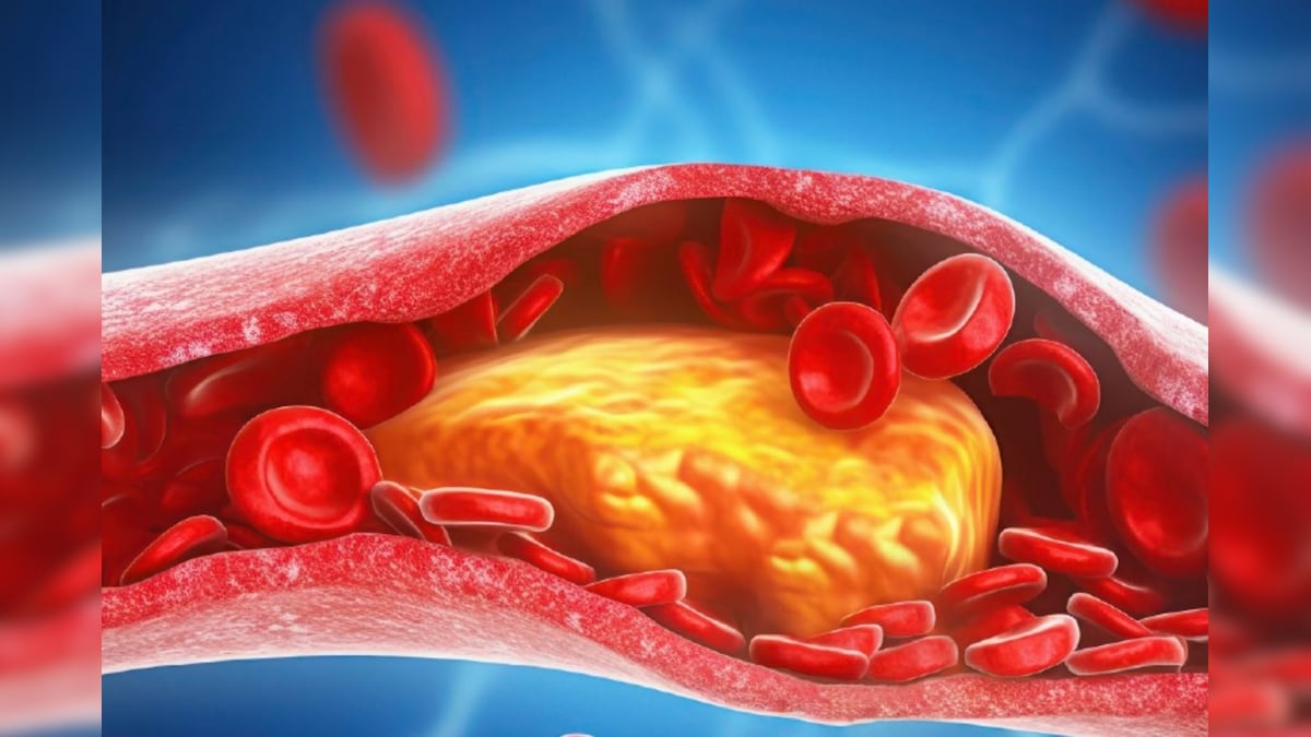 இந்த 5 உணவுகள் உடலில் அதிகரித்து வரும் கெட்ட கொலஸ்ட்ராலை நீக்கும் : நிபுணர்கள் விளக்கம்! 