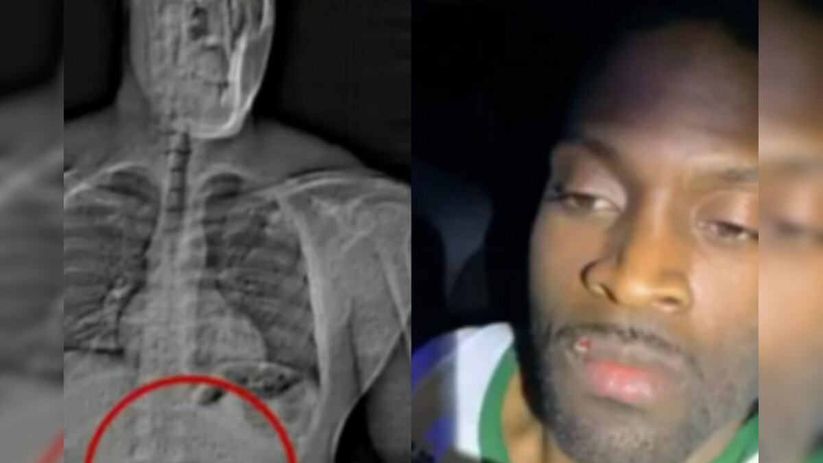 கைதாவதை தவிர்க்க ரூ.6 கோடி மதிப்புள்ள வைர காதணிகளை விழுங்கிய திருடன்... கடைசியில் நடந்தது என்ன...? - News18 தமிழ்