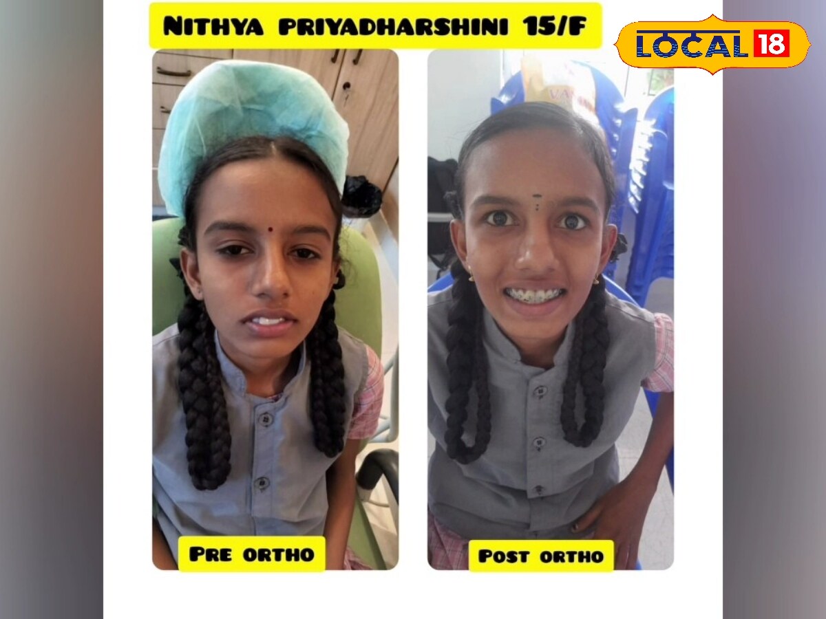 மலரும் புன்னகை : 600 அரசு பள்ளி மாணவர்களுக்கு இலவசமாக Braces எனப்படும் கிளிப் சிகிச்சை..!! - News18 தமிழ்