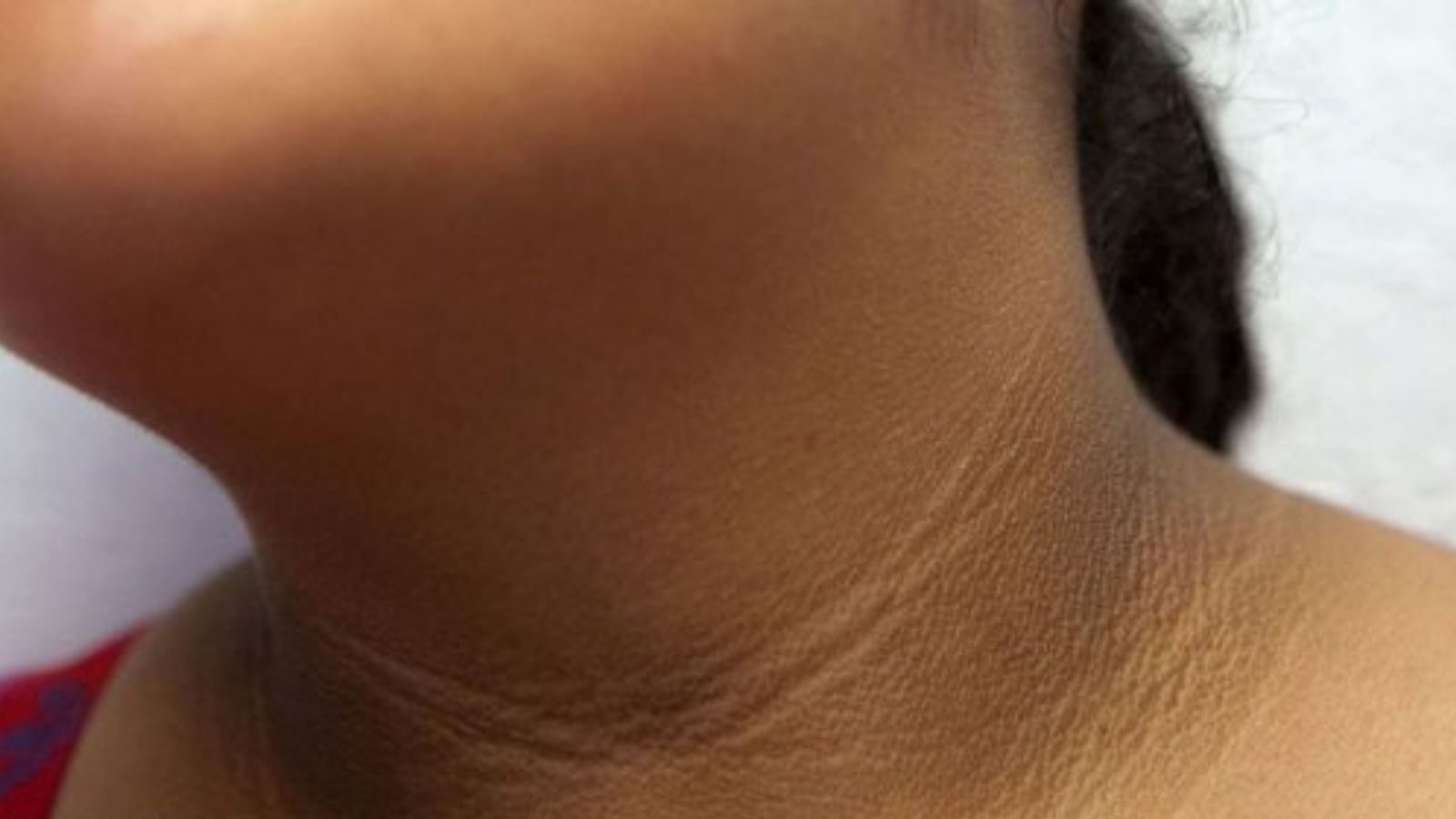 கழுத்துல கருப்பு கருப்பா கோடுகள் விழுந்திருக்கா..? அப்படின்னா ரொம்ப நாளா உங்களுக்கு இந்த பிரச்சனை இருக்கலாம்.! - News18 தமிழ்