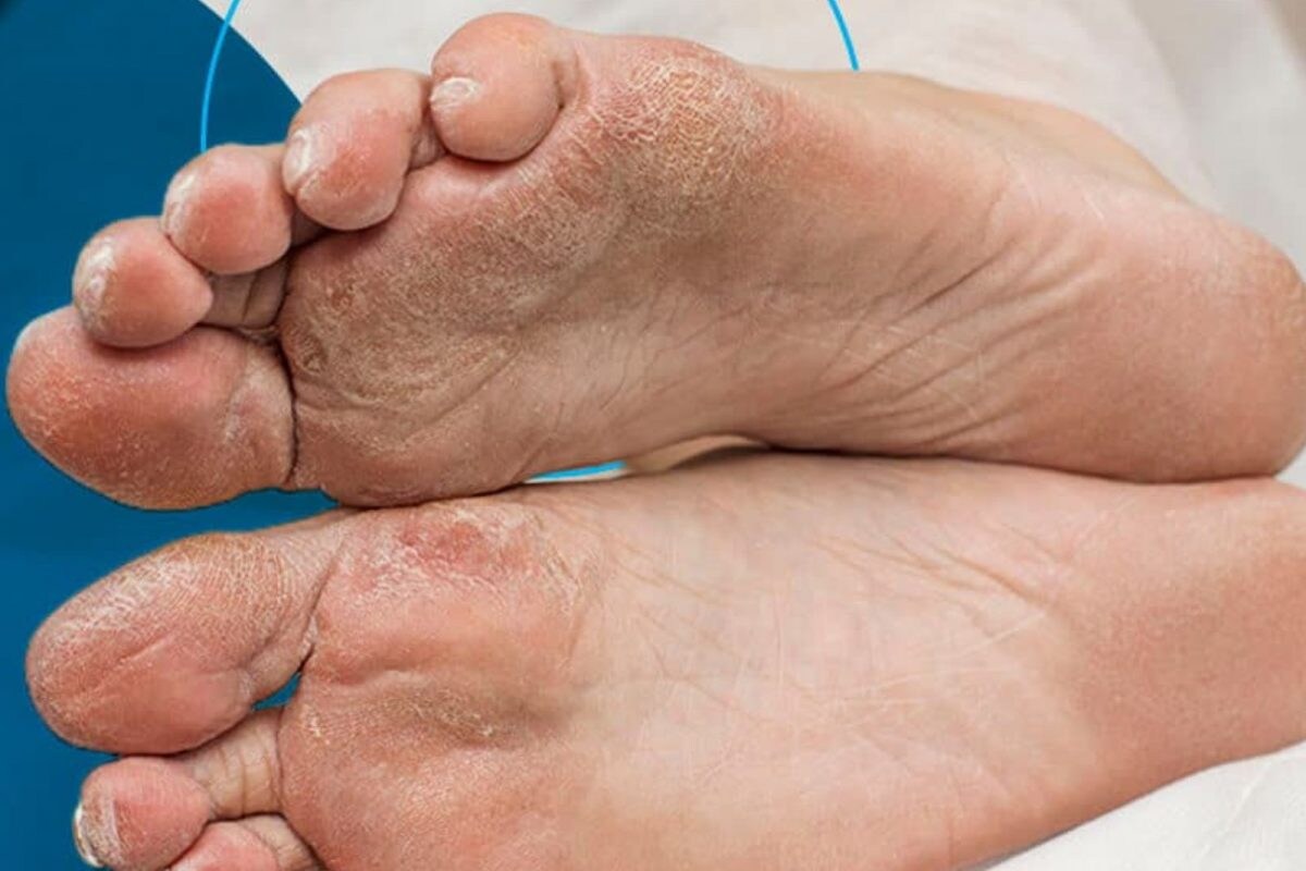 பாதங்களில் தெரியும் டயாபடீஸ் அறிகுறிகள்.. நீரிழிவு நோயாளிகளே உஷார்..! - News18 தமிழ்