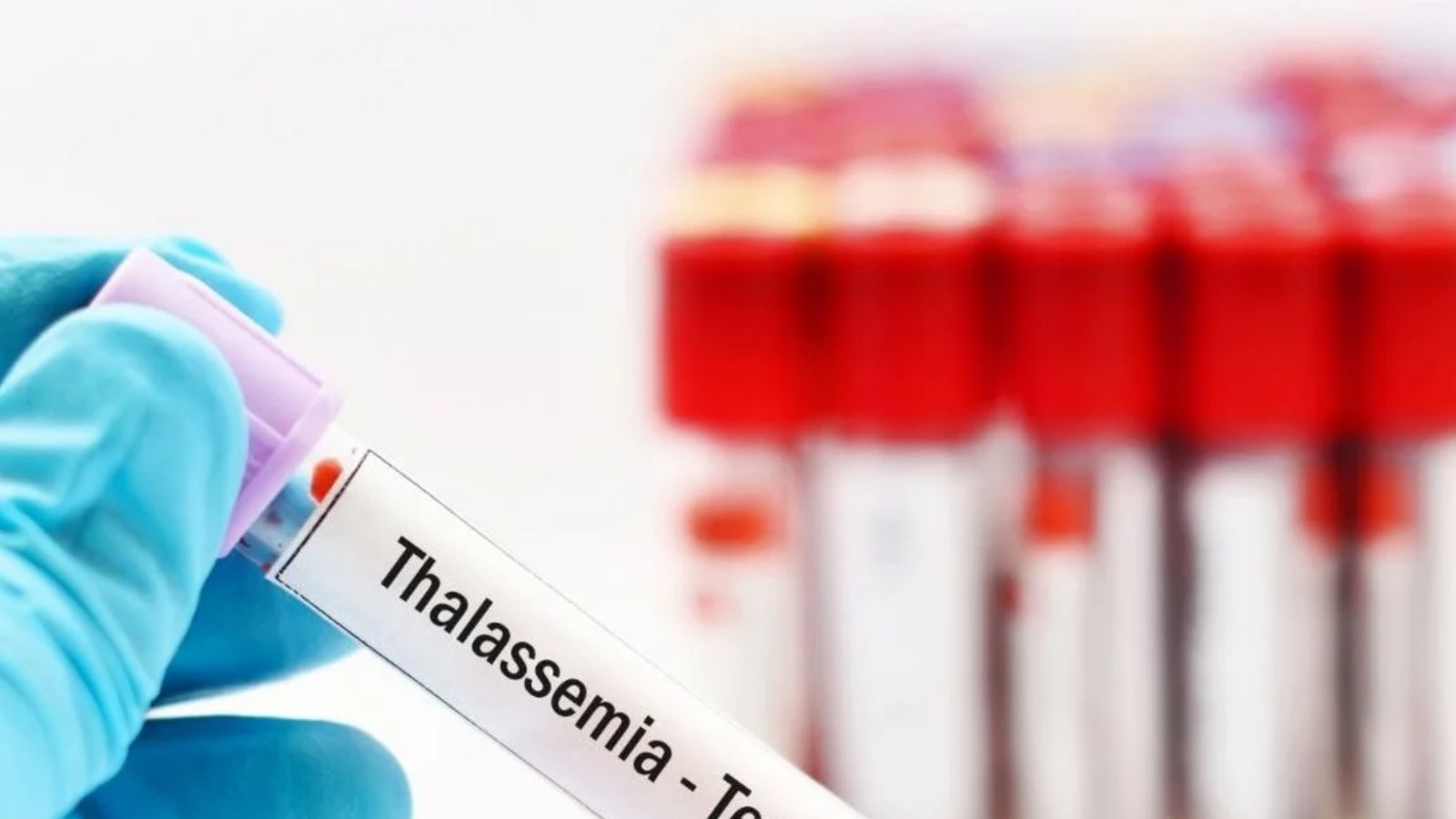 திருமணத்திற்கு முன் Thalassemia பரிசோதனை ஏன் முக்கியம்.. நிபுணர் விளக்கம்! - News18 தமிழ்