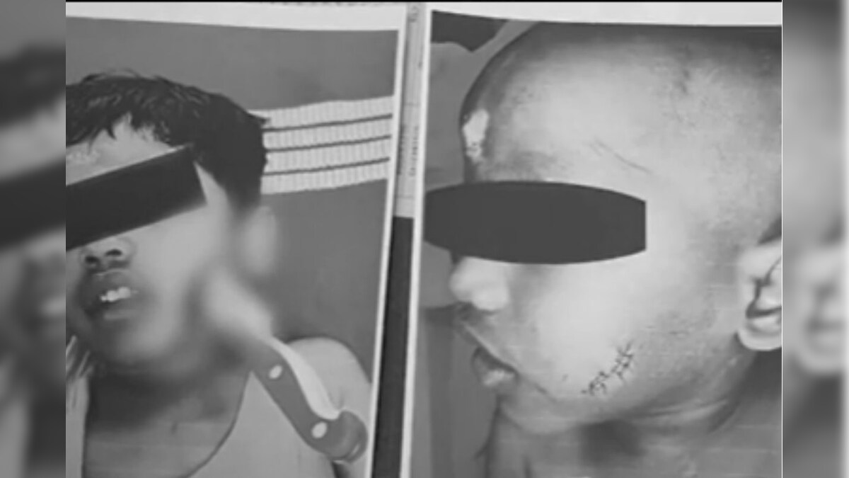 சிறுவனின் கன்னத்தில் துளைத்து மூளையின் அடிப்பகுதி வரை சென்ற கத்தி.. வெற்றிக்கரமாக அகற்றிய அரசு மருத்துவர்கள் - News18 தமிழ்