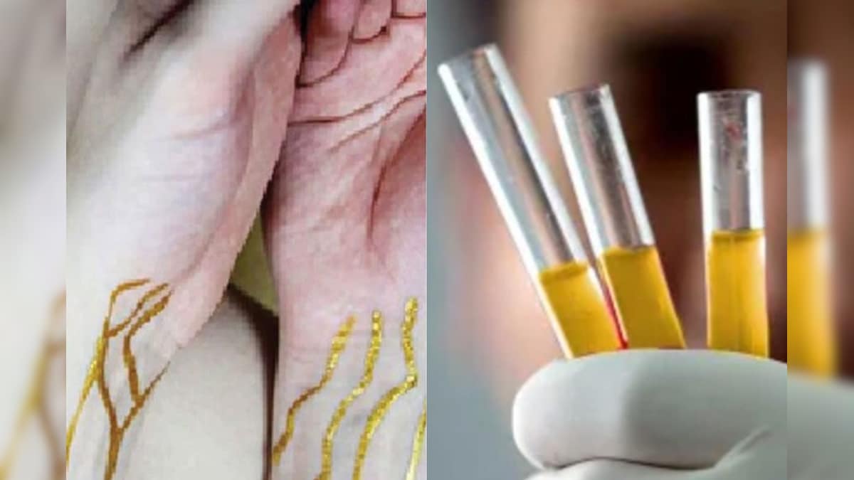 'தங்க இரத்தம்' பற்றி கேள்விப்பட்டிருக்கிறீர்களா? 50 பேருக்கு மட்டுமே இந்த இரத்த வகை உள்ளது.. ஏன் தெரியுமா?