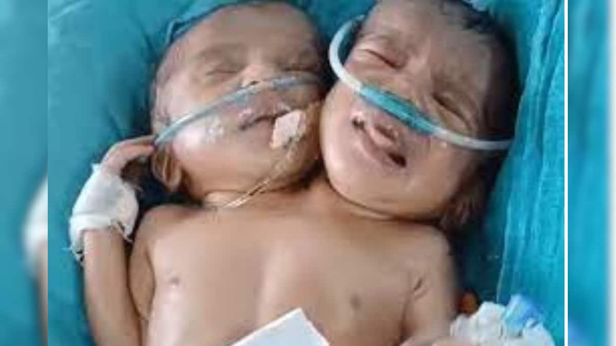 2 தலை, கல்லீரல், நுரையீரல்.. ஆனால் இதயம் ஒன்று.. ஒட்டி பிறந்த இரட்டை பெண் குழந்தைகள்..! - News18 தமிழ்