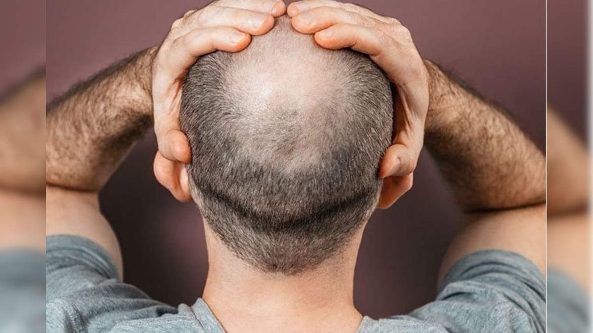 வழுக்கை கவலை.. இனி இல்லை.. ஆய்வில் அசத்திய ஆய்வாளர்கள்! | லைஃப்ஸ்டைல் - News18 தமிழ்