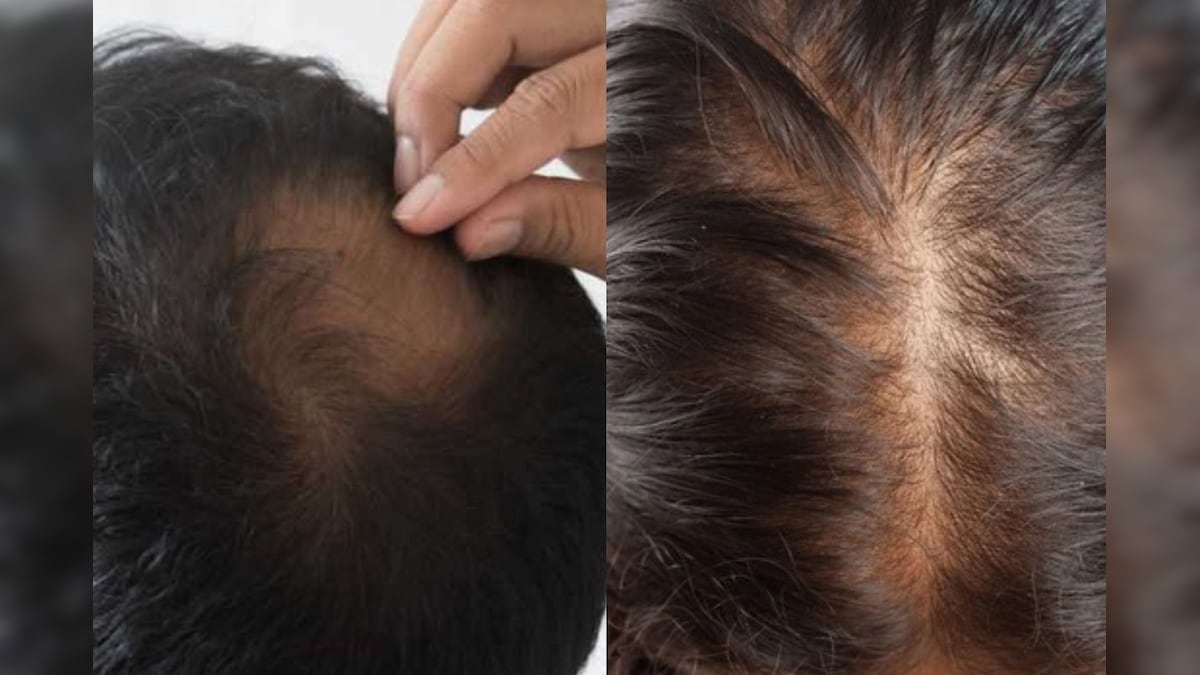 ஆண் , பெண் இருவருக்கும் எப்படி வழுக்கை அறிகுறிகள் மாறுபடுகிறது ..? பிரச்சனையை அறிந்து தடுக்கும் வழிகள்..! | லைஃப்ஸ்டைல் - News18 தமிழ்