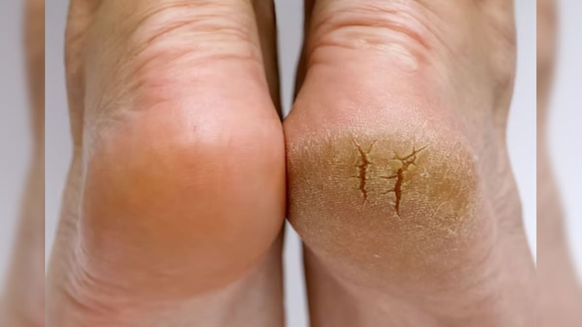 ஒரே வாரத்தில் பாத வெடிப்பு மறைஞ்சிடும்.. இந்த வீட்டு வைத்தியம் செஞ்சாலே போதும்..! | லைஃப்ஸ்டைல் - News18 தமிழ்