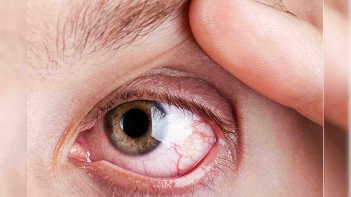 இந்த நோய் இருந்தால் கண் குருடாகும் வாய்ப்பு அதிகமாம்.. கவனம் தேவை..! | லைஃப்ஸ்டைல் - News18 தமிழ்