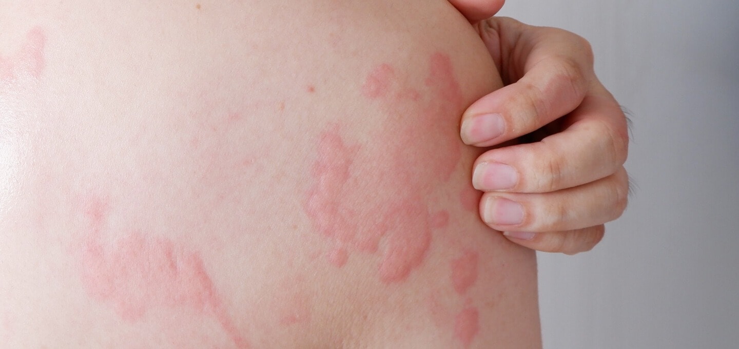 Hives vs rashes : இரண்டுக்குமான வித்தியாசம் என்ன..? அறிகுறிகளும் ...