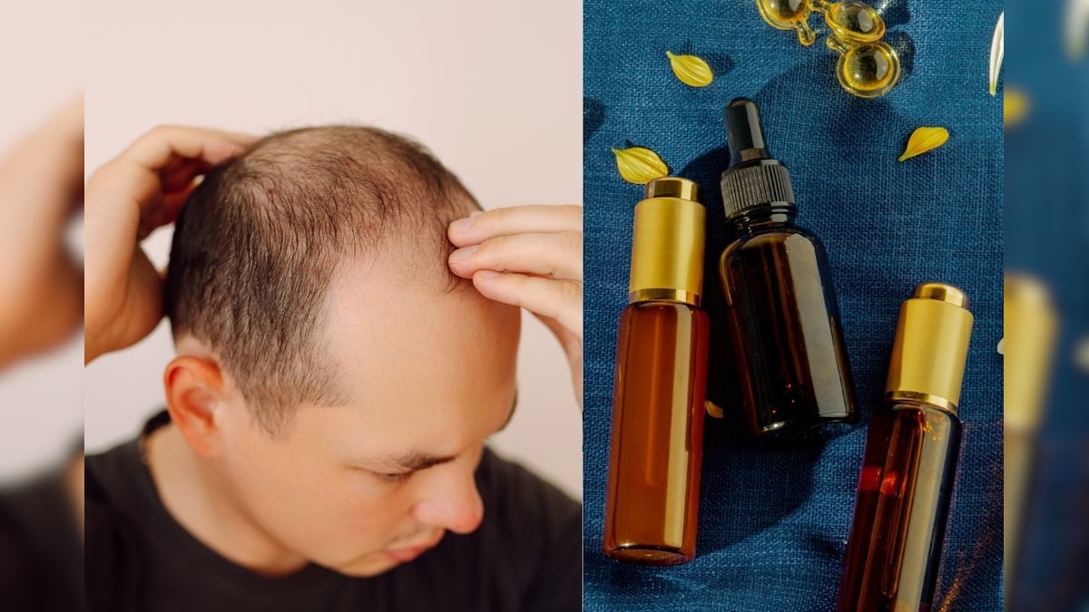 Baldness Reversible Serum | வழுக்கைத்தலை பிரச்னையை 20 நாட்களில் பக்கவிளைவுகளே இல்லாமல் போக்கும் சீரம் ரெடி? | லைஃப்ஸ்டைல் - News18 தமிழ்