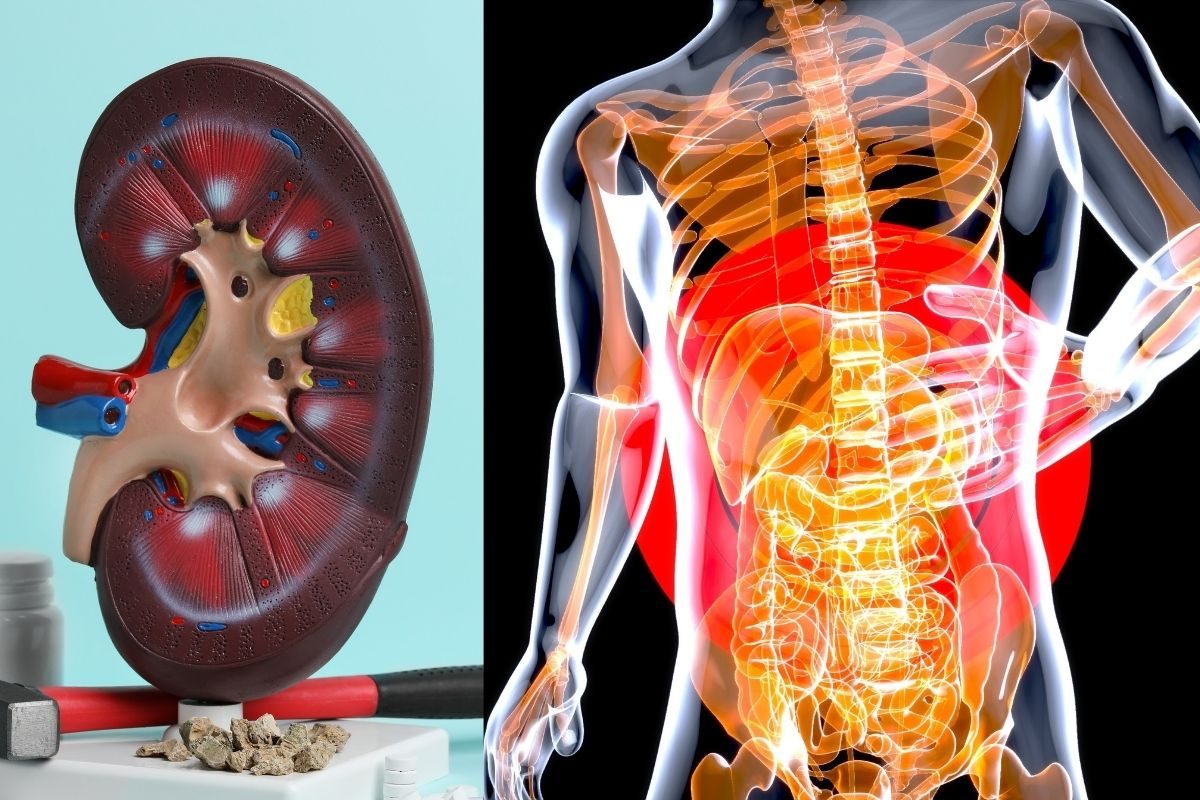 Kidney Stone | எல்லா சிறுநீரகக் கற்களுக்கும் அறுவை சிகிச்சை தேவையா?