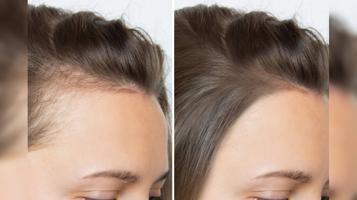 கொத்து கொத்தா கொட்டுற முடி ஒரே வாரத்துல சரியாகிடும்.. இந்த டிப்ஸ் ஃபாலோ பண்ணுங்க.! | லைஃப்ஸ்டைல் - News18 தமிழ்