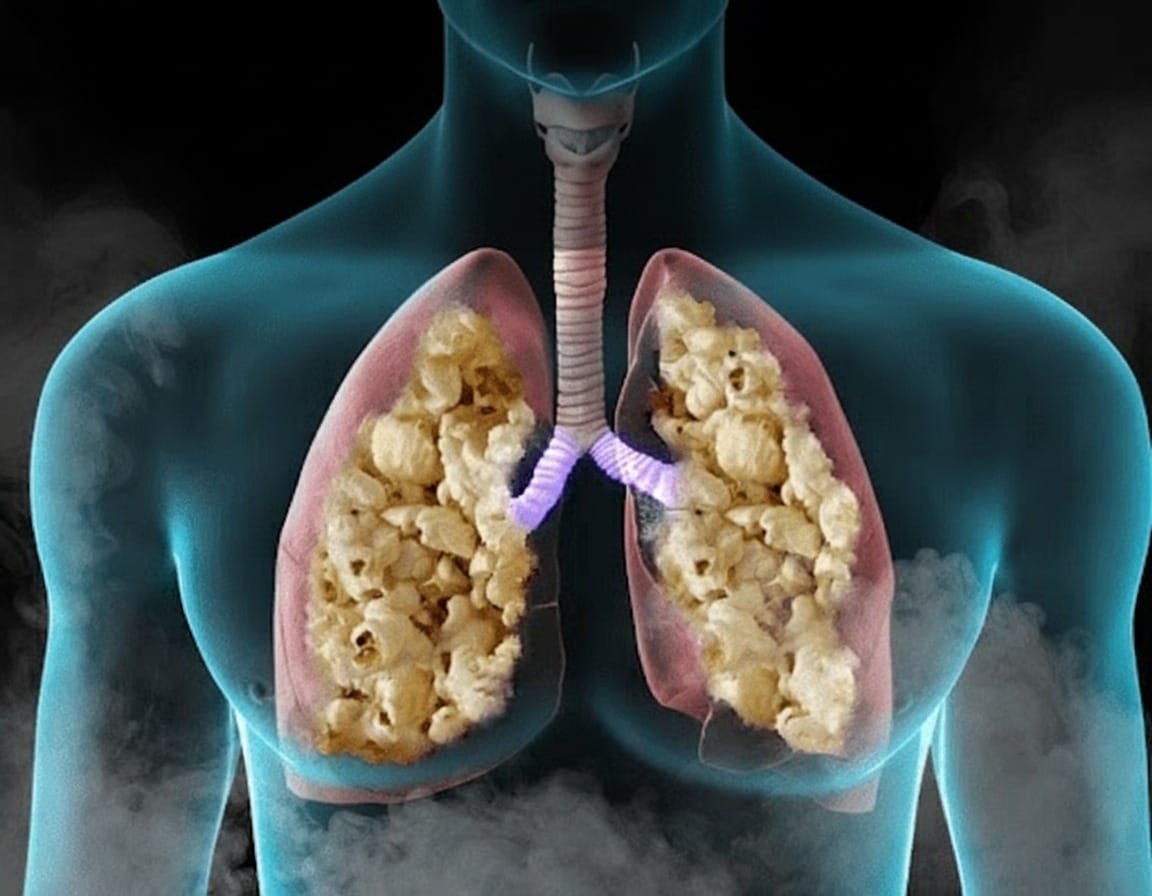How Many Reported Cases Of Popcorn Lung