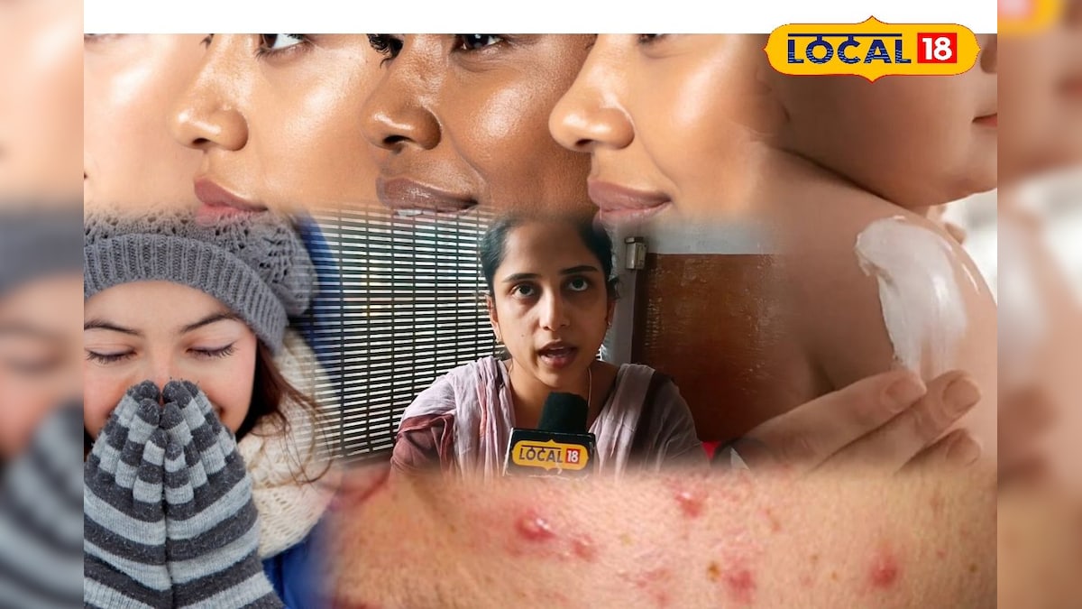 Winter Skin Care: குளிர்காலத்தில் வரும் சரும பிரச்சினைகள்... மருத்துவர் சொல்லும் டிப்ஸ்... | லைஃப்ஸ்டைல் - News18 தமிழ்