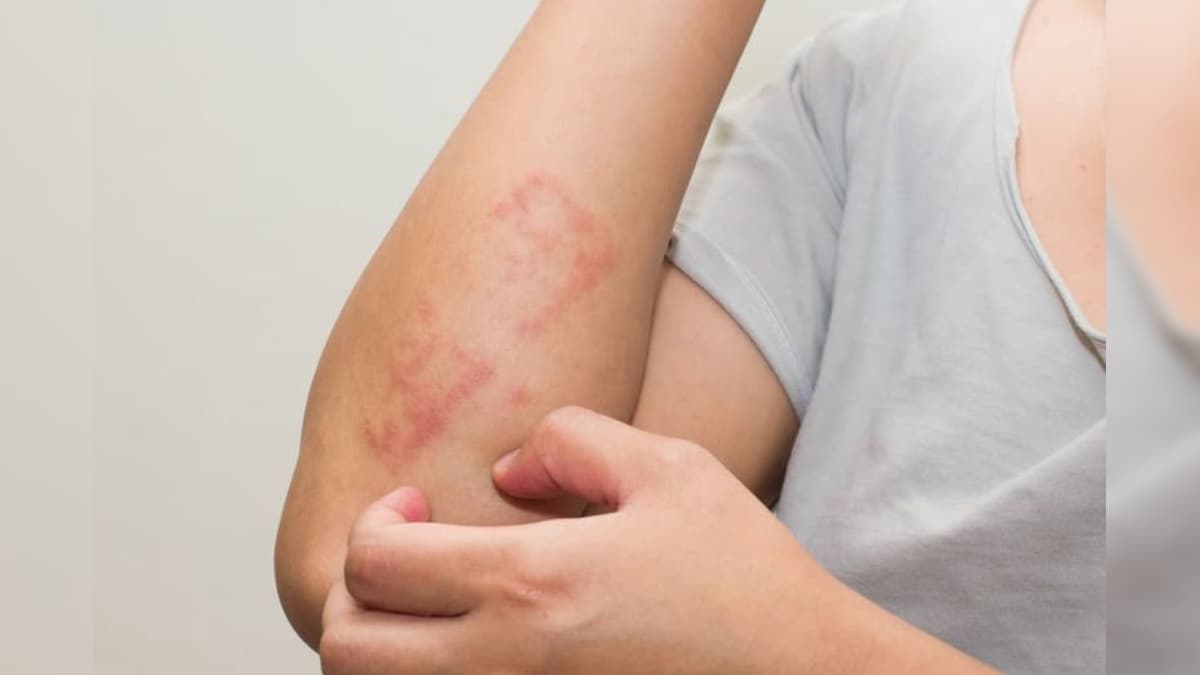 கை, கால், முகம் ஆகிய இடங்களில் அரிப்பு.. எந்த நோயின் அறிகுறி தெரியுமா..? எச்சரிக்கை..! | லைஃப்ஸ்டைல் - News18 தமிழ்