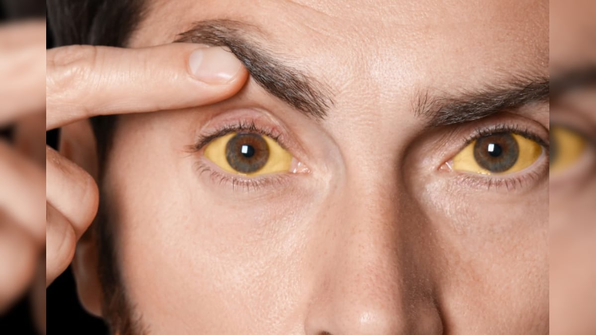 இனியும் மஞ்சள் காமாலை பருவகால நோய் அல்ல... பயமுறுத்தும் நவீன வாழ்க்கை முறை! | லைஃப்ஸ்டைல் - News18 தமிழ்