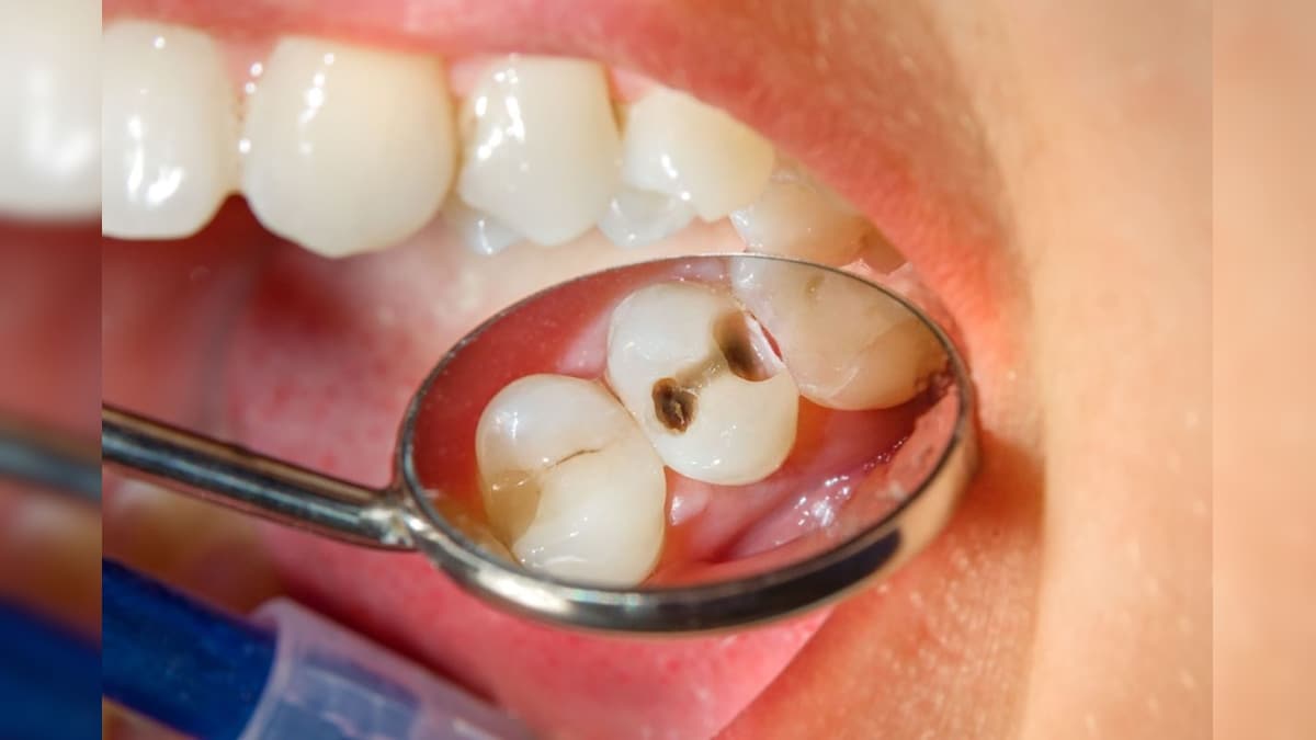 பல் சொத்தையாவதற்கு இந்த உணவுகள்தான் காரணம்.. இன்றே தவிர்த்திடுங்க..! | லைஃப்ஸ்டைல் - News18 தமிழ்