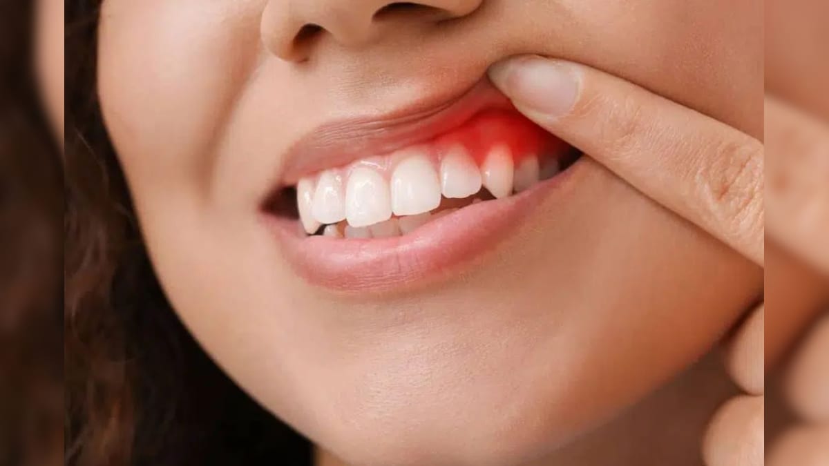 ஈறுகளுக்குள் ஒளிந்திருக்கும் ஆபத்து: மோசமான பழக்கம் பக்கவாதத்தை ஏற்படுத்தும் - எச்சரிக்கும் ஆய்வு | லைஃப்ஸ்டைல் - News18 தமிழ்