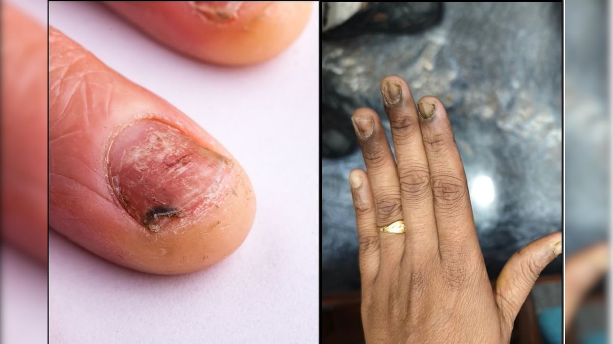 வலுவிழந்த கருப்பான நகங்கள்... எதனால் ஏற்படுகிறது? எப்படி தடுப்பது? மருத்துவர் கொடுக்கும் டிப்ஸ்! | லைஃப்ஸ்டைல் - News18 தமிழ்