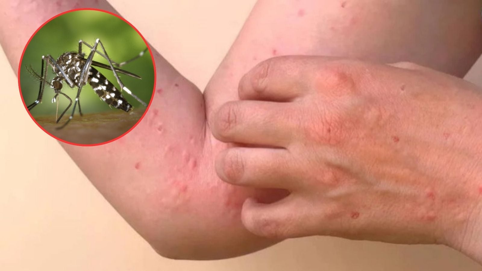 சென்னை உட்பட 8 மாவட்டங்கள் சிக்குன் குனியா பரவல் அதிகரிப்பு.. சுகாதரத்துறை எச்சரிக்கை..! | லைப்ஸ்டைல் போட்டோகேலரி - News18 தமிழ்