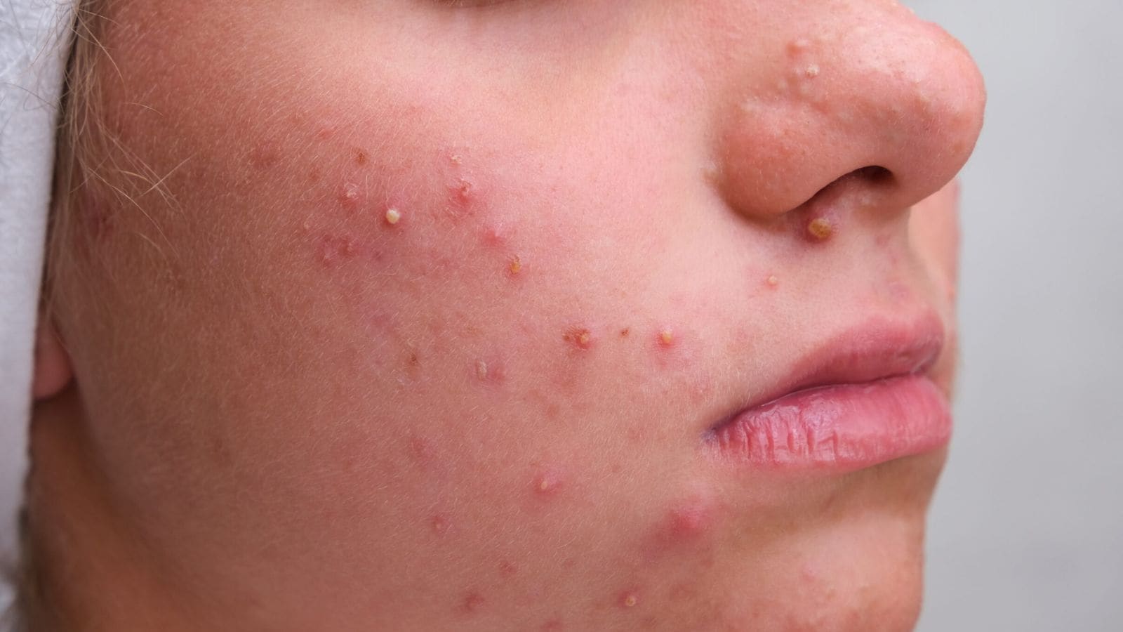 முகப்பரு, பருக்கள் தீர்க்கும் நெல்லிக்காய், வேம்பு, கற்றாழை மூலிகைகள் | லைப்ஸ்டைல் போட்டோகேலரி - News18 தமிழ்