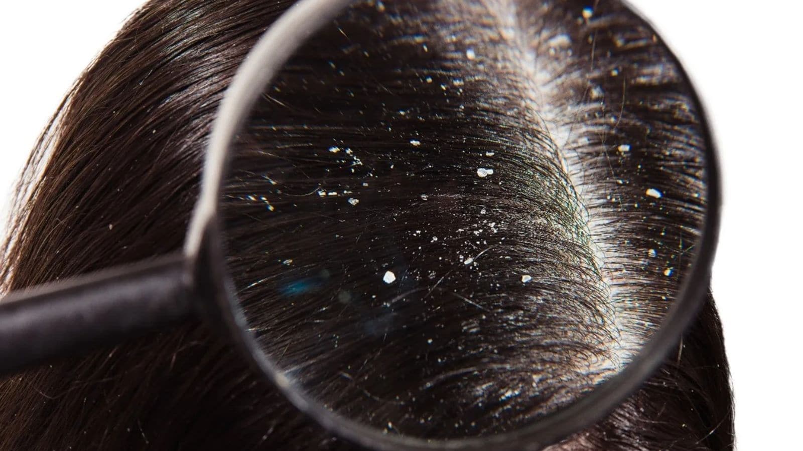 என்ன செஞ்சாலும் பொடுகு பிரச்சனை போகவே மாட்டேங்குதா..? இதுதான் காரணம்..! | லைப்ஸ்டைல் போட்டோகேலரி - News18 தமிழ்