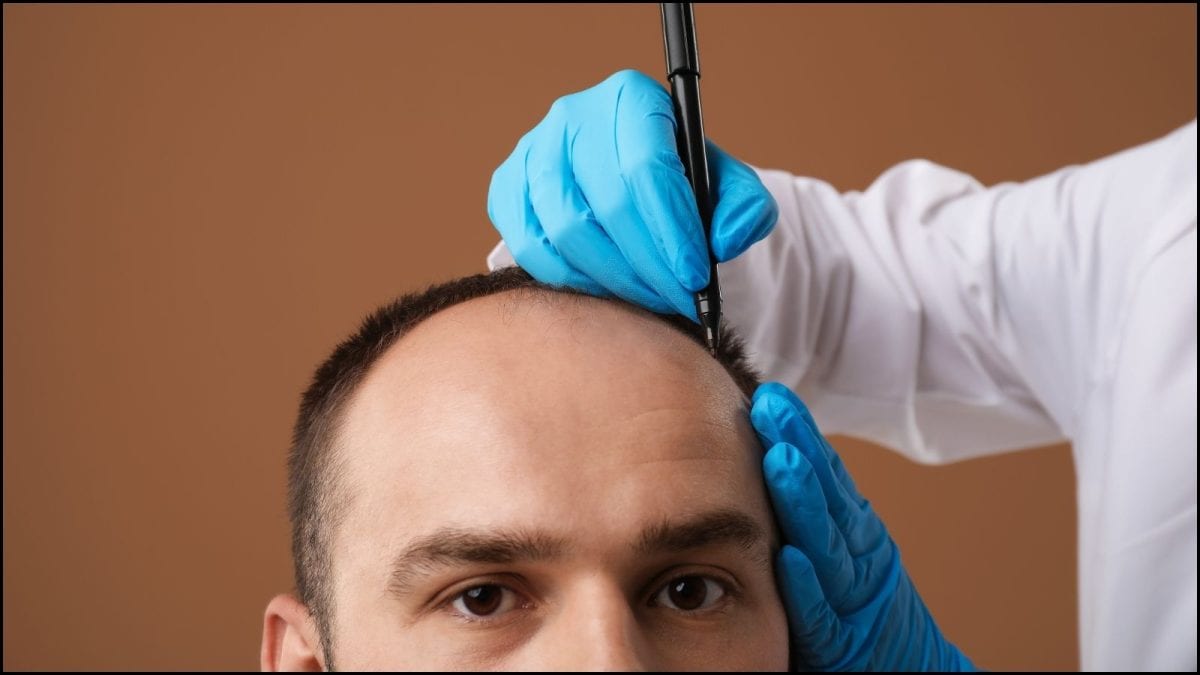 முடி மாற்று அறுவை சிகிச்சைக்கு கட்டுப்பாடுகள் விதித்த தமிழக அரசு! | Health News (சுகாதார செய்திகள்) - News18 தமிழ்