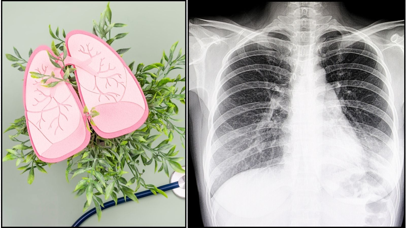 அதிகரிக்கும் நிமோனியா பரவல்... அறிகுறிகள் என்னென்ன? யாரெல்லாம் கவனமாக இருக்க வேண்டும்? அவசியம் தெரிஞ்சுக்கோங்க! | லைப்ஸ்டைல் போட்டோகேலரி - News18 தமிழ்