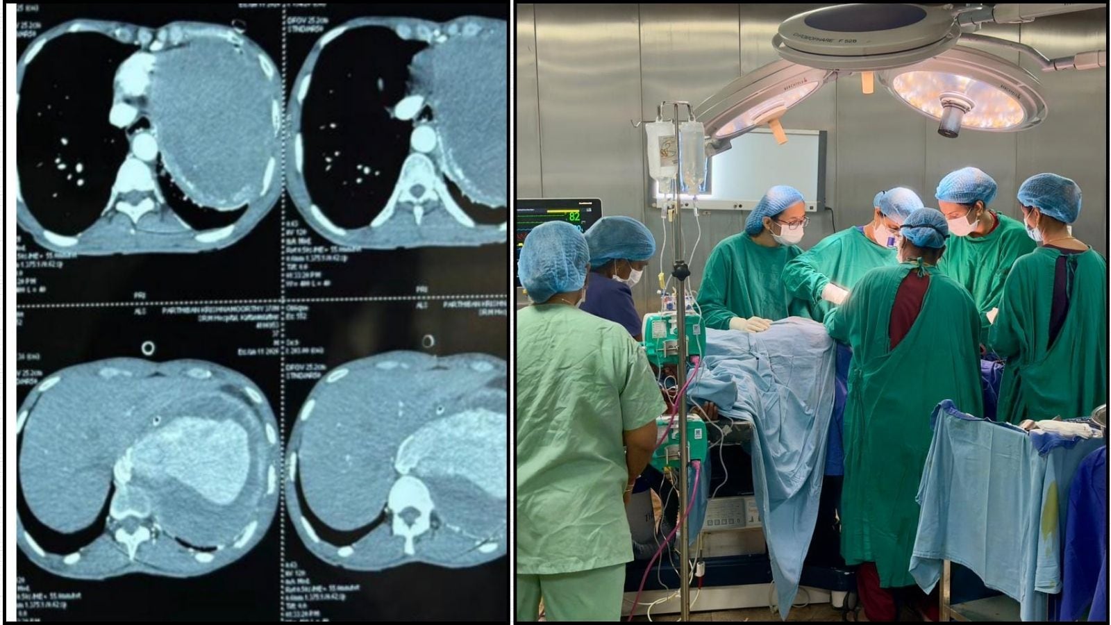 ரூ.30-40 லட்சம் தேவைப்படும் சிகிச்சை... இலவசமாக செய்து கூலித்தொழிலாளர்கள் உயிரைக் காப்பாற்றிய அரசு மருத்துவர்கள்! | Health News (சுகாதார செய்திகள்) - News18 தமிழ்