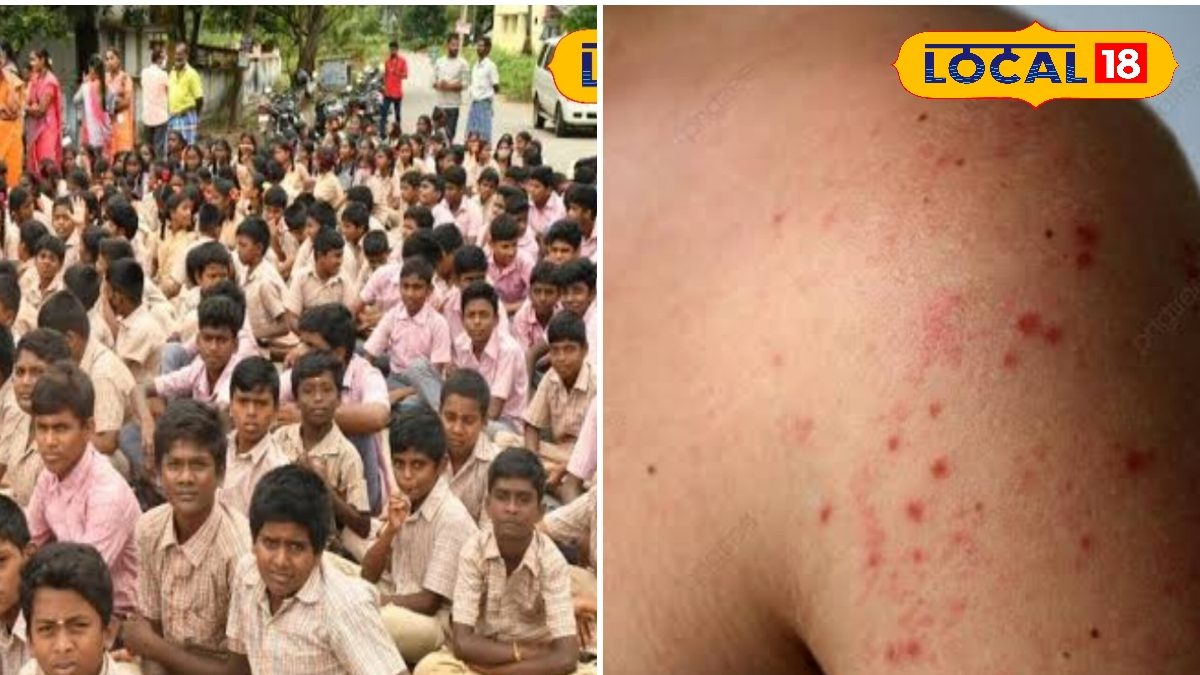 கோடையில் பள்ளிகளில் சின்னம்மை பரவல்... சுகாதாரத் துறை வெளியிட்ட எச்சரிக்கை...