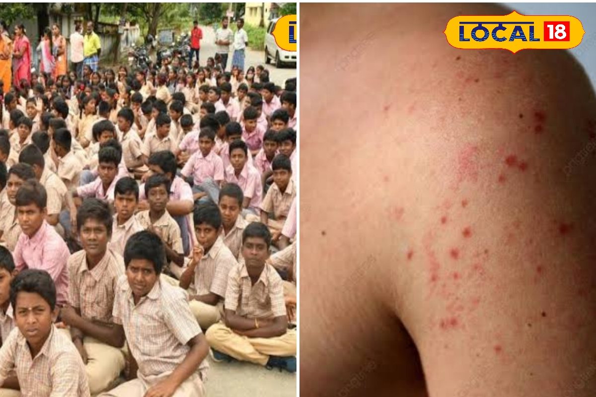 கோடையில் பள்ளிகளில் சின்னம்மை பரவல்... சுகாதாரத் துறை வெளியிட்ட எச்சரிக்கை...