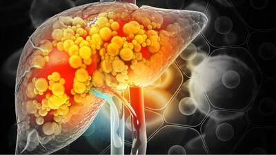 fatty liver