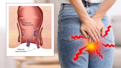 hemorrhoids