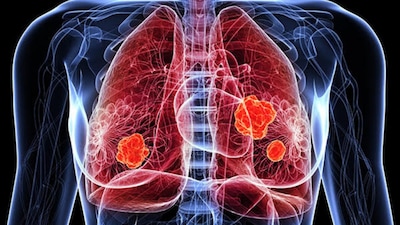 lung cancer