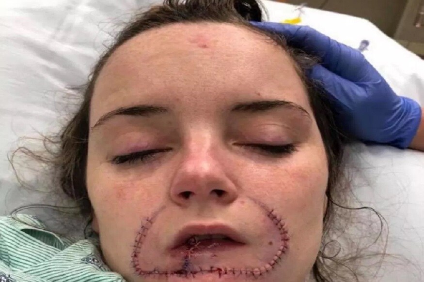 kiss, lip lock kiss, kiss kills, lady get 300 stitches after lip-lock kiss, forceful kiss, kissed girl friend hardly, deep lip-lock kiss, ముద్దు, అదర చుంబనం, ముద్దు పెడితే ప్రియురాలి మూతి పగిలింది, ముద్దు పెట్టినందుకు జైలుశిక్ష, ప్రియురాలి మూతికి 300 కుట్లు, సౌత్ కరోలినా