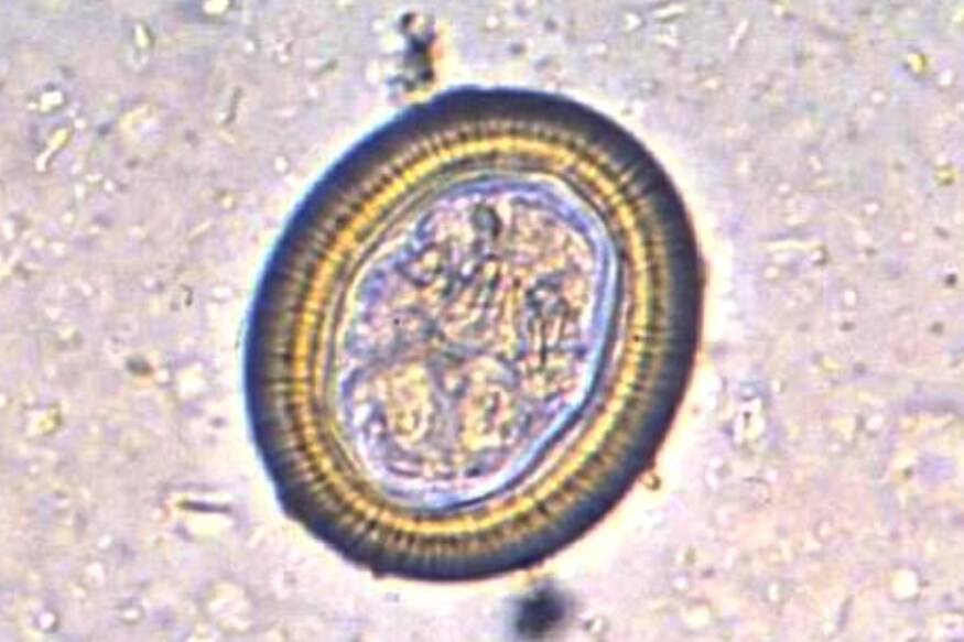 Rachel Palma, Brain Tumor, Tapeworm, Neurocysticercosis Parasitic, Brain Infection, Taenia Solium Tapeworm, rare operation, brain surgery, రాచెల్ పల్మా, న్యూయార్క్ డాక్టర్లు, టేప్ వార్మ్, మెదడులో పురుగు, బ్రెయిన్ లో పురుగు,