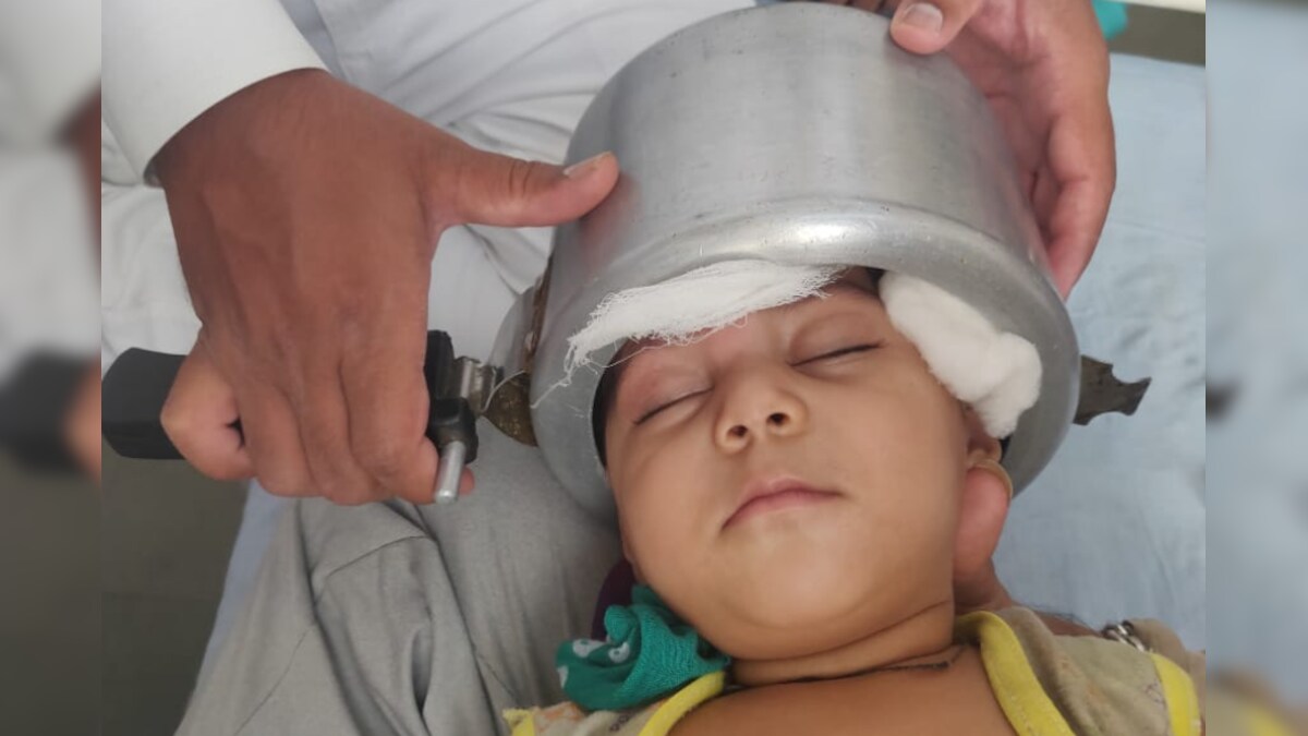 కుక్కర్‌లో తలపెట్టిన ఏడాది పాప... చివరకు ఇలా తీశారు.. One Year Old