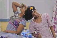 Twins Operation: మన వీణా వాణి అలాంటి కవలకు ఆపరేషన్.. తరువాత ఏం జరిగిందంటే..