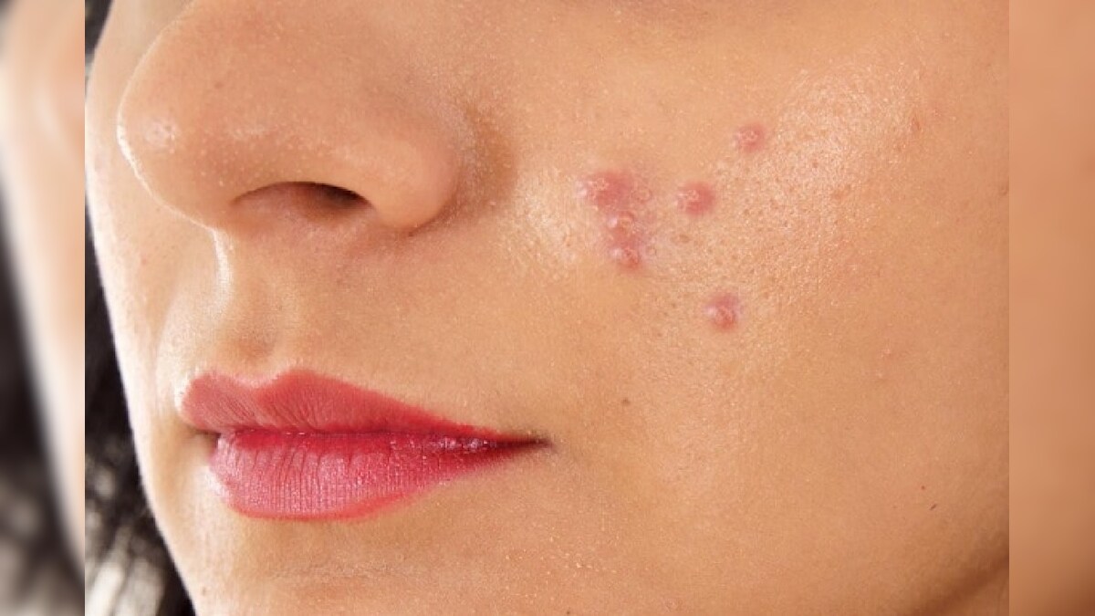 Pimples: అక్కడ మొటిమలు వచ్చాయంటే.. మీలో ఈ వ్యాధి ఉన్నట్లే.. జాగ్రత్త ...