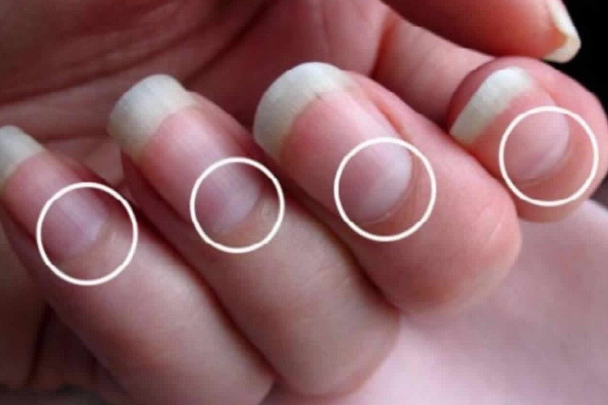 5 Health Problems The Half Moons on Nails Can Warn You About