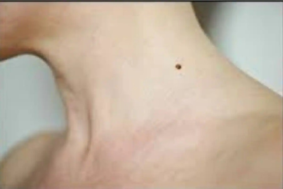 Mole theory: మీకు పుట్టుమచ్చలున్నాయా ...