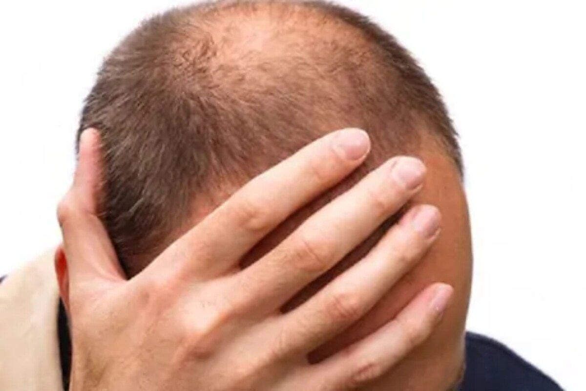  Covid 19 Deaths: బట్టతల ఉన్నవారికి అదే ఓ పెద్ద సమస్యలా ఉంటుంది. అలాంటిది వారికి ఇప్పుడు కరోనా ఓ బ్యాడ్ న్యూస్ తెచ్చింది. తలపై జుట్టు తక్కువగా ఉండేవారికి... కరోనా సోకితే...చనిపోయే అవకాశాలు ఎక్కువగా ఉంటున్నాయి. జుట్టు ఉన్నవారు అంత ఎక్కువగా చనిపోవట్లేదు. కరోనా ఫస్ట్ వేవ్ వచ్చినప్పుడు ఇలాగే జరిగింది. సెకండ్ వేవ్‌కి కూడా ఇదే సమస్య వస్తోంది. (ప్రతీకాత్మక చిత్రం)