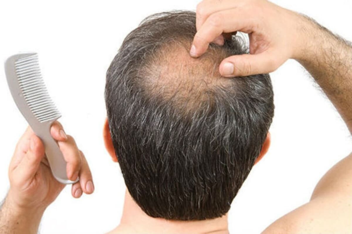  అందువల్ల బట్టతల ఉండేవారు కరోనా వైరస్‌కి దొరకకుండా ఎక్కువ జాగ్రత్తలు తీసుకోవడం మేలు అని ఈ పరిశోధనలు హెచ్చరిస్తున్నాయి. పొరపాటున అలాంటి వారికి కరోనా సోకితే... వీలైనంత త్వరగా ట్రీట్‌మెంట్ పొందేలా అలర్ట్ అవ్వాలని చెబుతున్నారు. (ప్రతీకాత్మక చిత్రం)