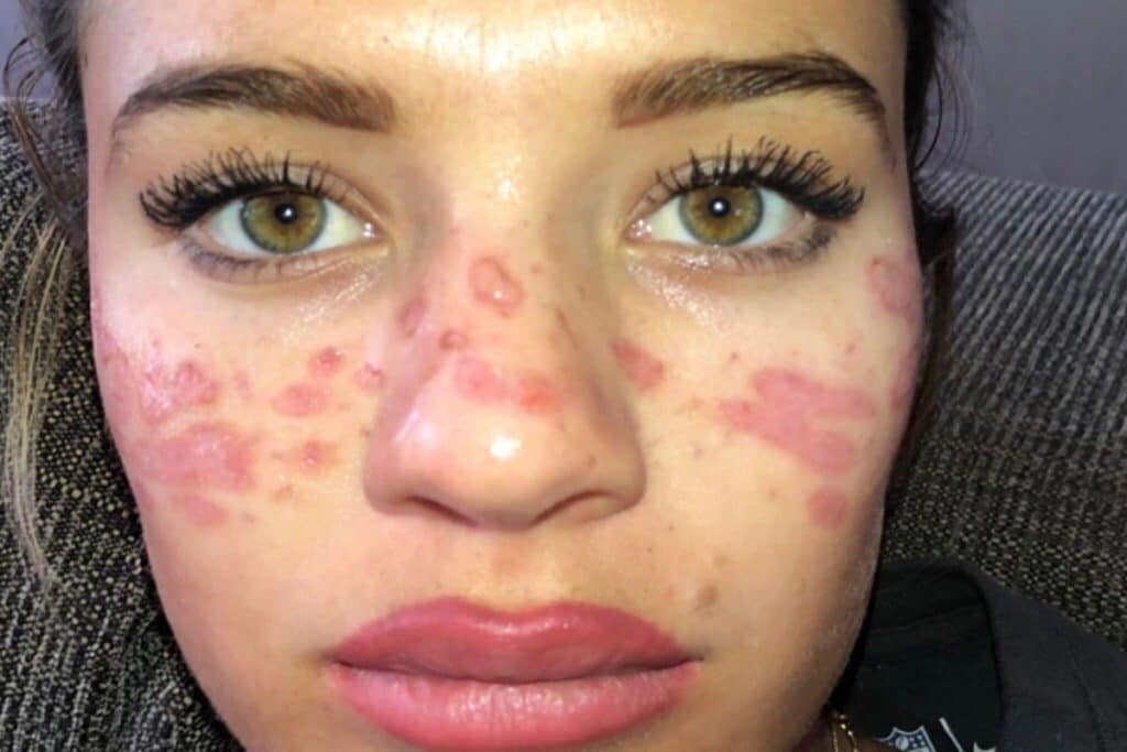  బిగ్ బ్రదర్ షోలో ఆమె... తన ఫేసుకు బ్లూ క్లే ఫేస్ మాస్క్ ధరించింది. అలా ఎందుకు ధరించావని నెటిజన్లు అడిగారు. దాంతో అసలేం జరిగిందో ఇన్‌స్టాగ్రామ్ ద్వారా తెలిపింది. (image Credit - Instagram - tillywhitfeld)